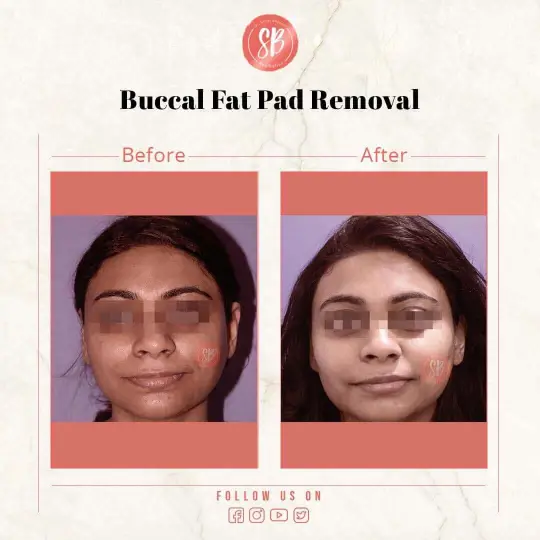 Buccal Fat Pad Removal