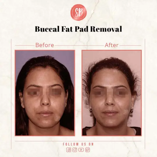 Buccal Fat Pad Removal