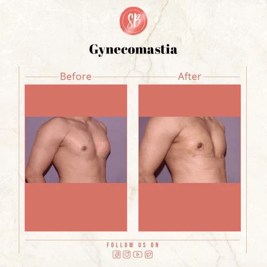 Best Plastic Surgeon in Gurgaon Before After