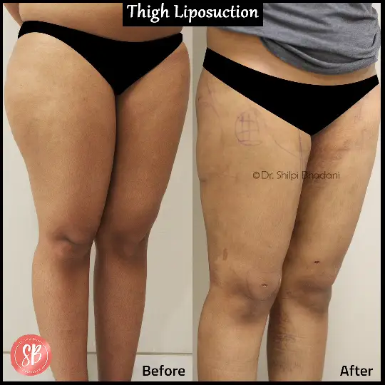 Best Plastic Surgeon in Gurgaon Before After