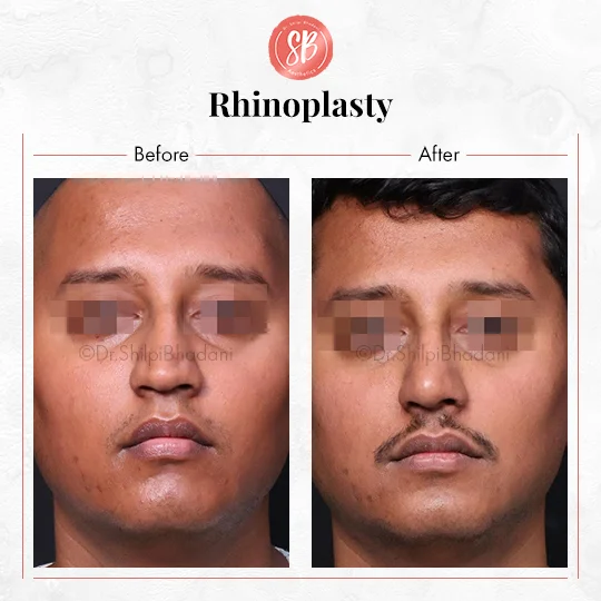 Best Plastic Surgeon in Gurgaon Before After