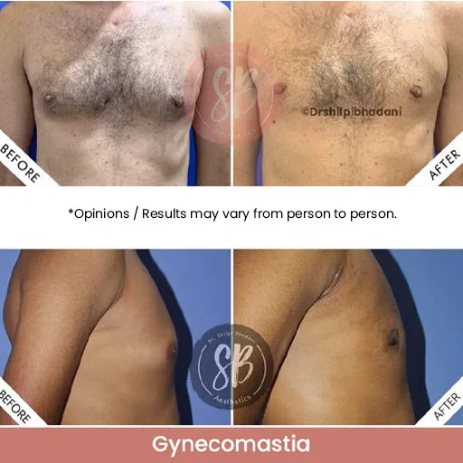 Gynecomastia