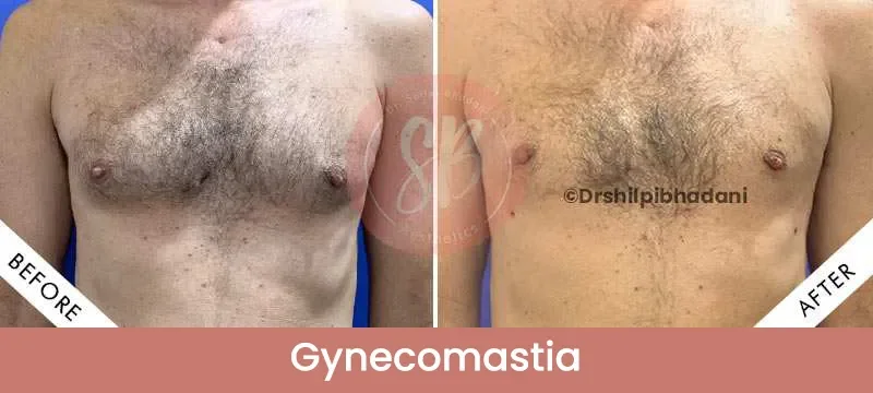 Gynecomastia