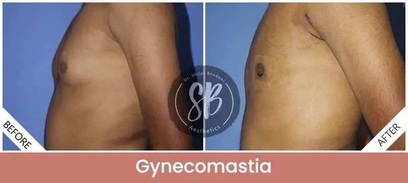 Gynecomastia