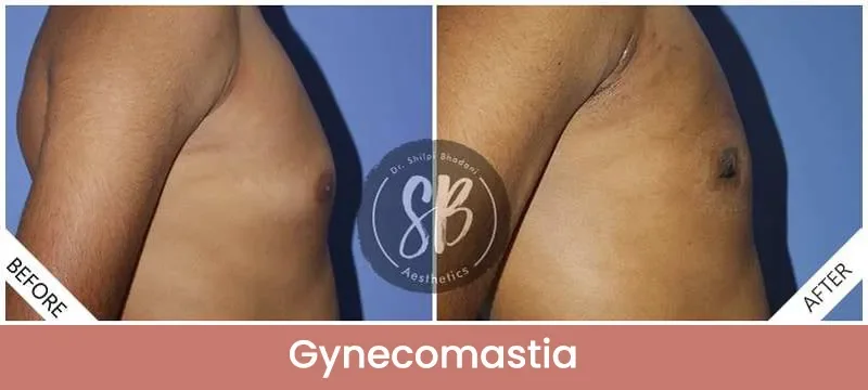 Gynecomastia