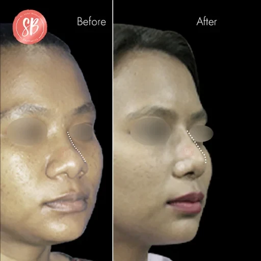 Rhinoplasty