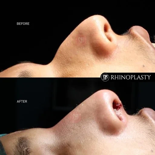Rhinoplasty