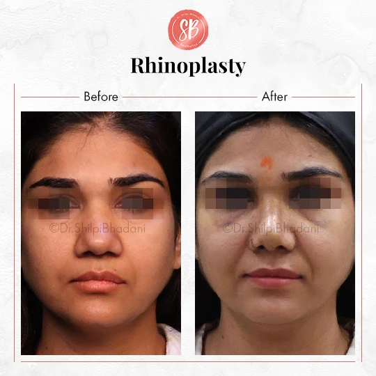Rhinoplasty