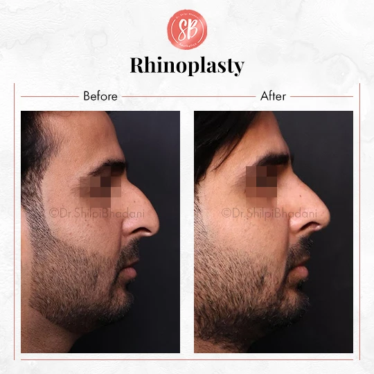 Rhinoplasty
