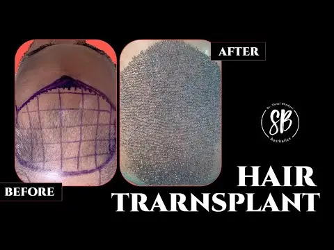 Hair Transplant Surgery