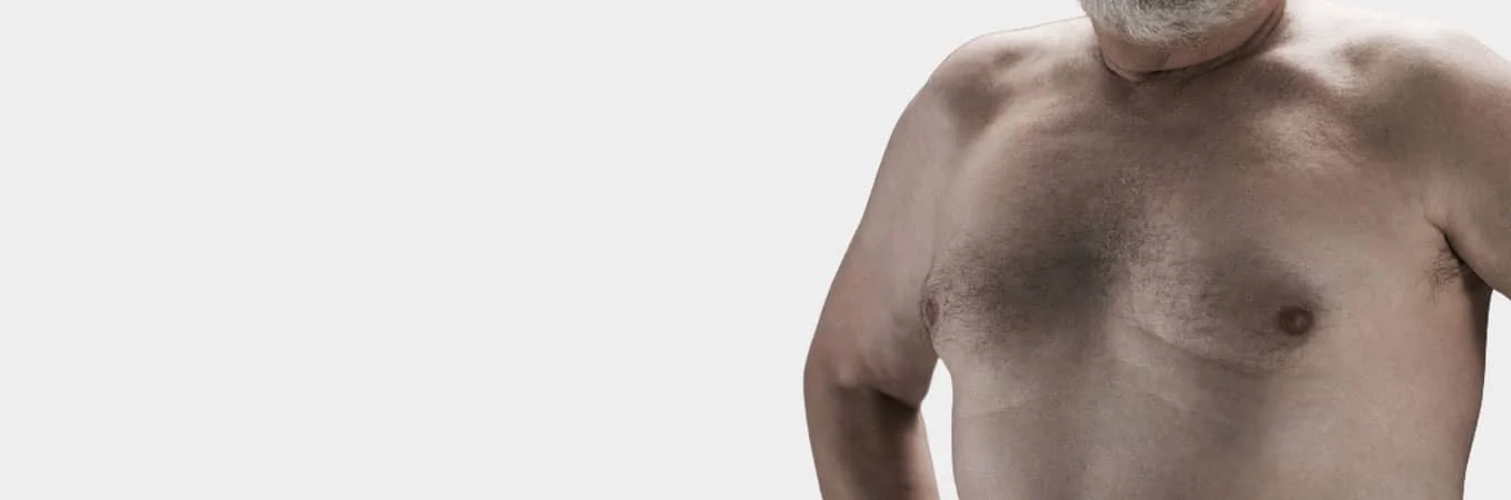 Gynecomastia Surgery in India