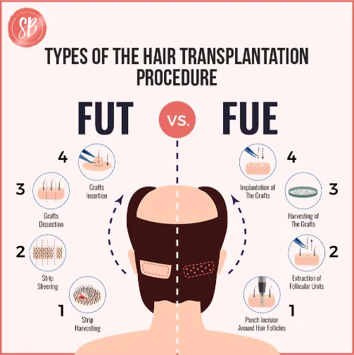 types of hair transplant - FUT vs FUE