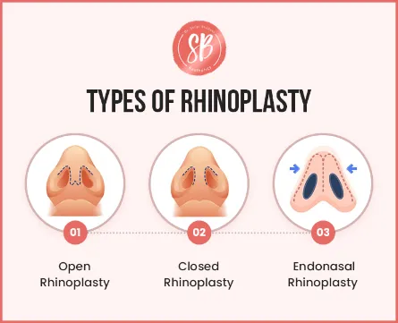 Types of rhinoplasty
