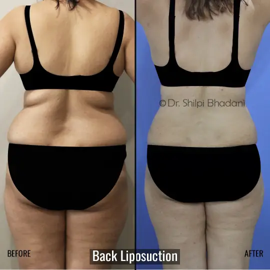 Back Liposuction Before and After