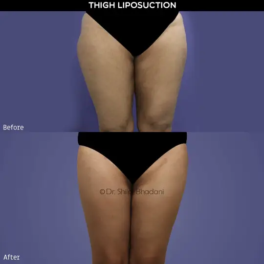 Thigh Liposuction Before and After - Result