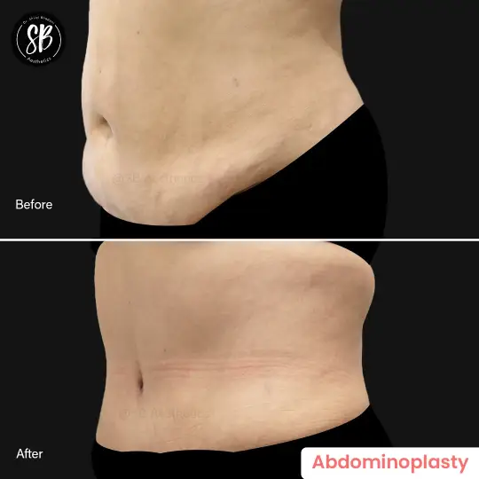 abdominoplasty before and after