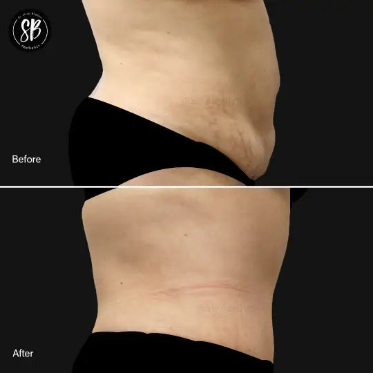 Abdominoplasty/tummy tuck before and after