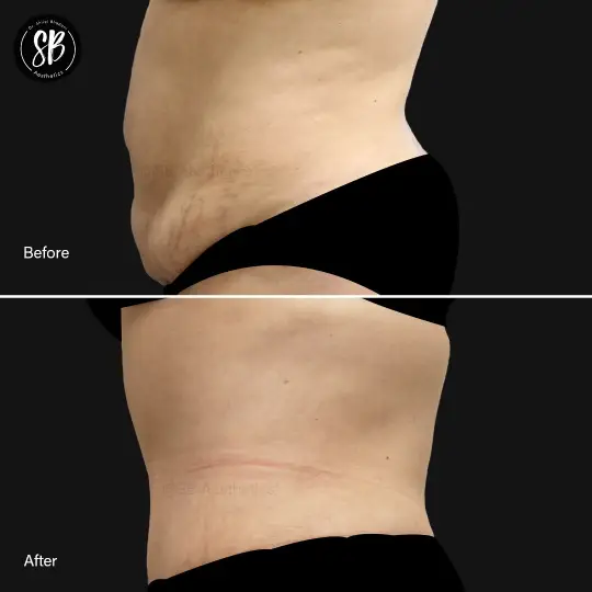 Abdominoplasty/tummy tuck before after