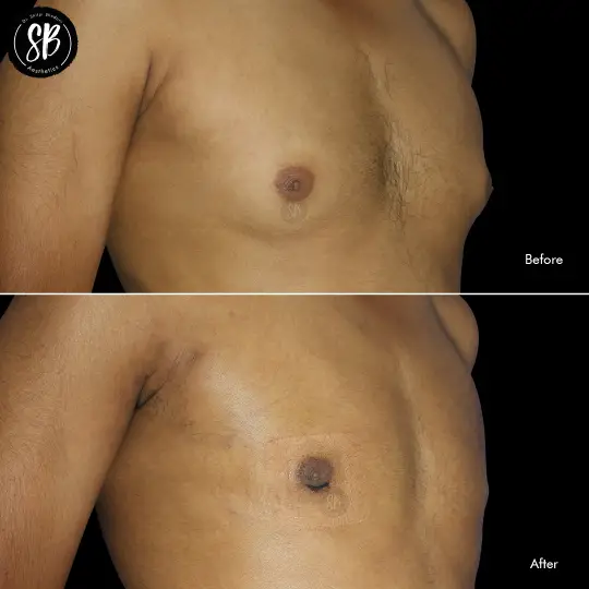 Gynecomastia