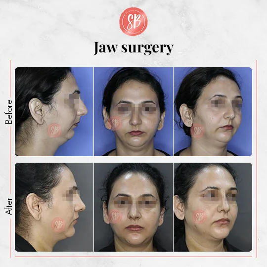Jaw Surgery Real Result - SB Aesthetics Clinic