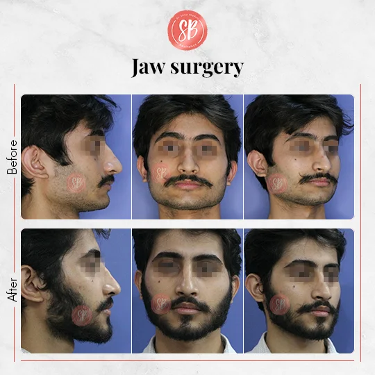 Jaw Surgery Real Result - SB Aesthetics Clinic