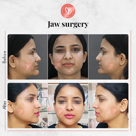 Jaw Surgery Real Result - SB Aesthetics Clinic