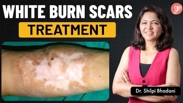 White Skin After a Burn? Causes, Pigment Loss & Best Treatments | Dr. Shilpi Bhadani | SB Aesthetics