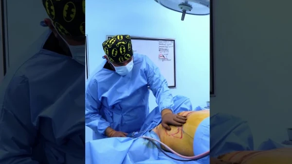 Gynecomastia Surgery #gynecomastia #sbaesthetics