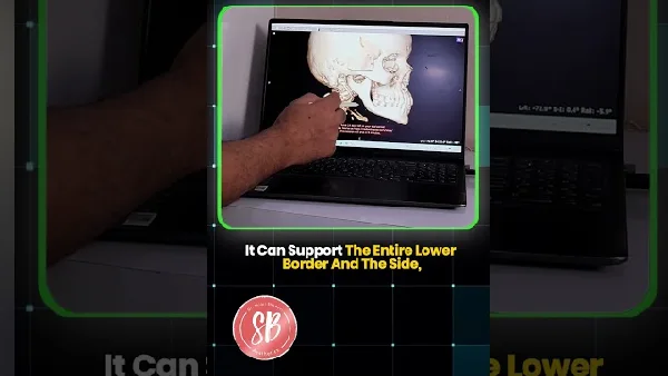 Inside the 3D Planning Process of V Line Surgery #medicaleducation #jawsurgery #surgery