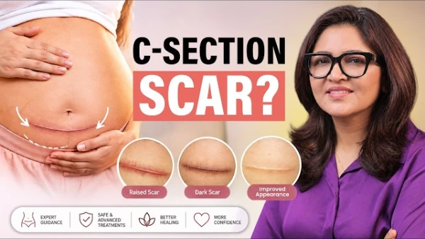 C-Section Scar Care: Do You Need Treatment?